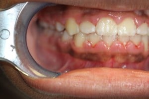 orthodontics-after-1
