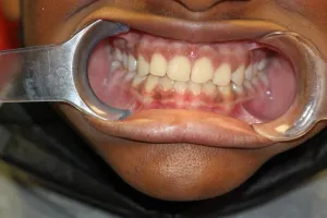 orthodontics-after-2