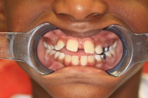 orthodontics-before-2