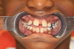 orthodontics-before-2