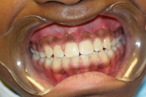 orthodontics-before-3