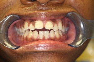 Close-up of a child's teeth before dental treatment at Pediatric Dentistry with Dr. Loretta Smith.